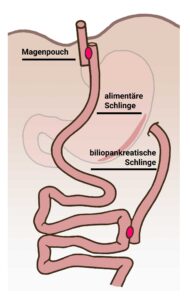 Der Roux Y-Magenbypass