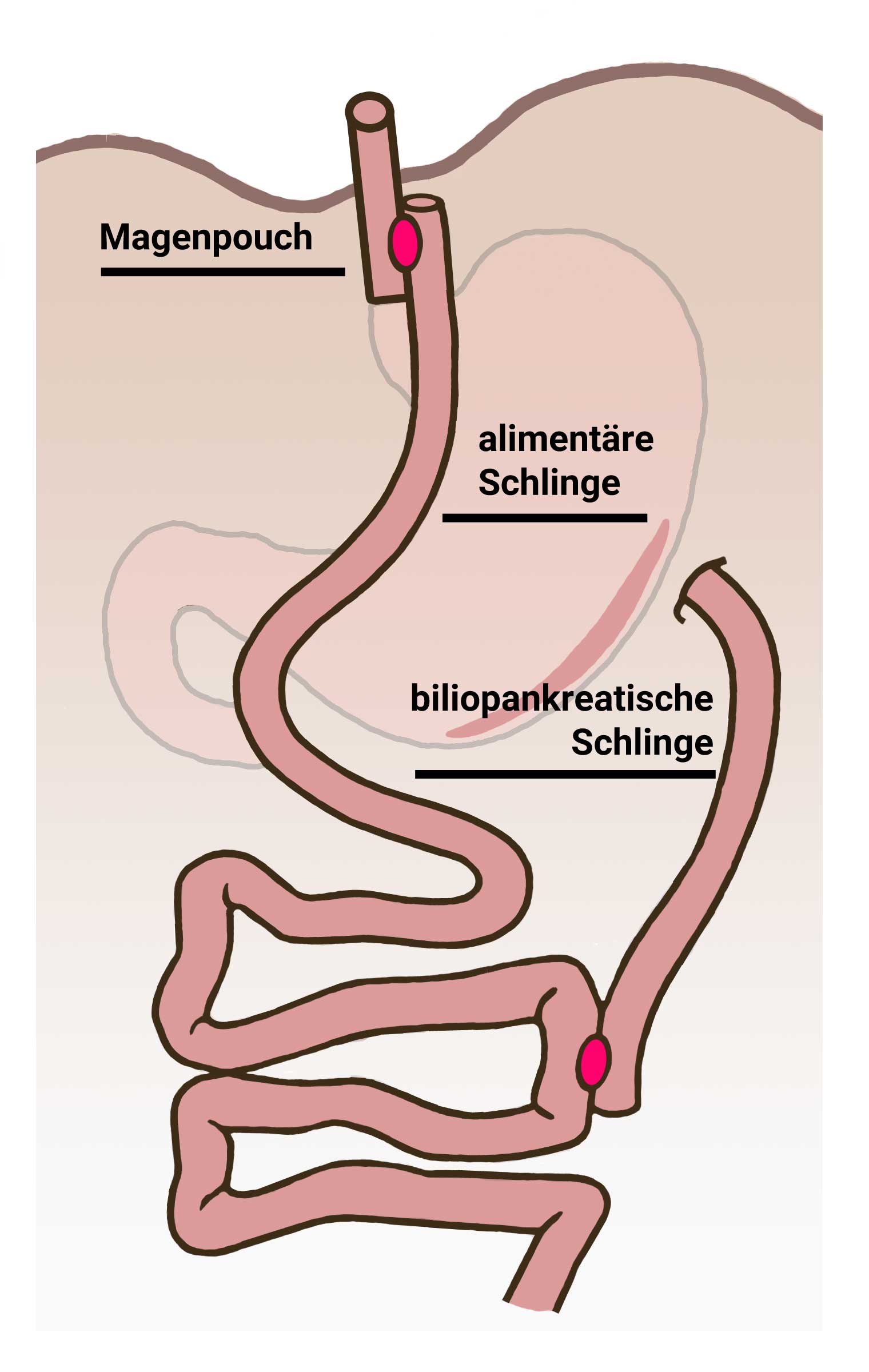 Der Roux Y-Magenbypass