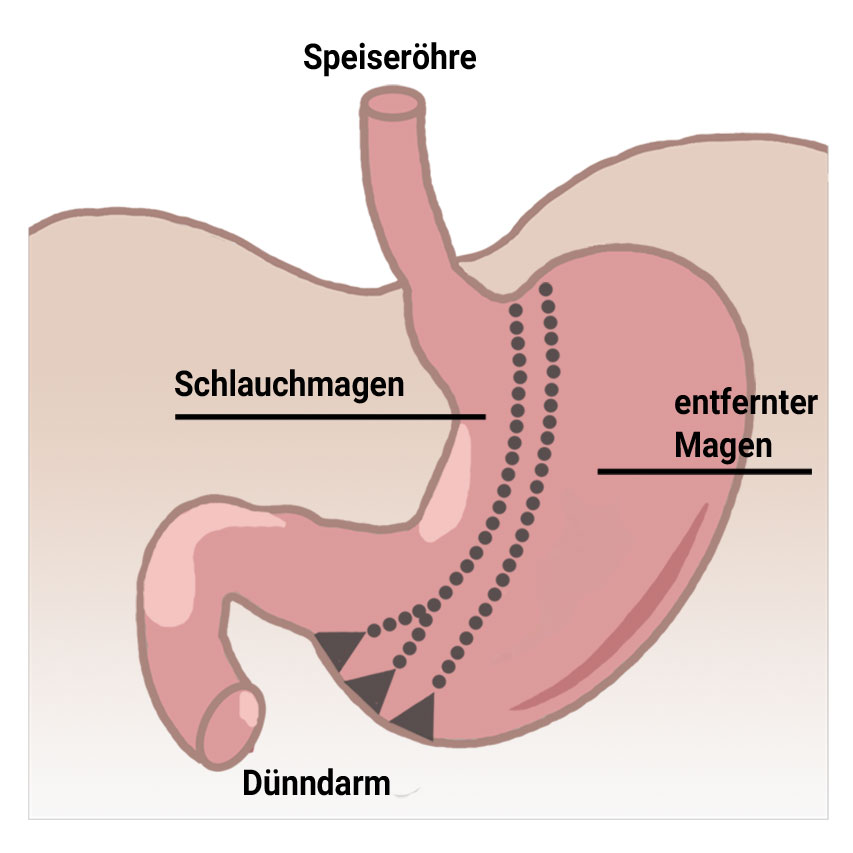 Der Schlauchmagen